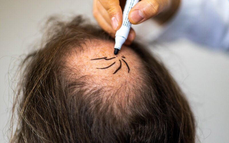 مراقبت‌های پس از کاشت مو برای نتیجه‌ای ماندگار