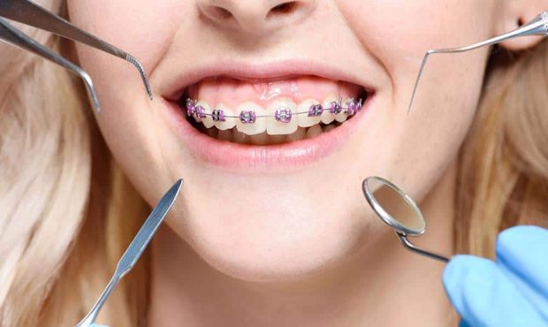 همه چیز درباره هزینه ارتودنسی دندان در سال ۱۴۰۴ + نکات مهم قبل از شروع درمان