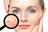 رابطه مصرف لبنیات صنعتی و تشدید آکنه پوستی رابطه مصرف لبنیات صنعتی و تشدید آکنه پوستی