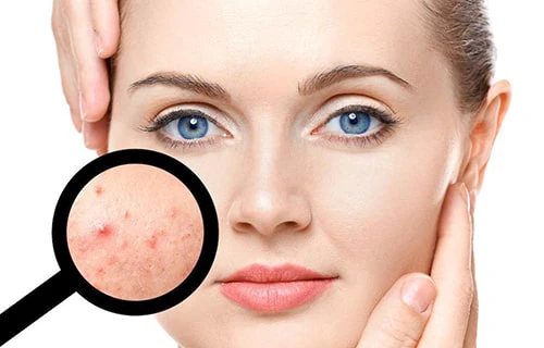 رابطه مصرف لبنیات صنعتی و تشدید آکنه پوستی