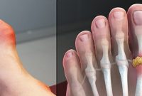 مضرات مصرف گوشت و افزایش خطر ابتلا به نقرس مضرات مصرف گوشت و افزایش خطر ابتلا به نقرس