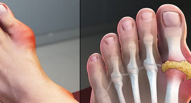 مضرات مصرف گوشت و افزایش خطر ابتلا به نقرس مضرات مصرف گوشت و افزایش خطر ابتلا به نقرس