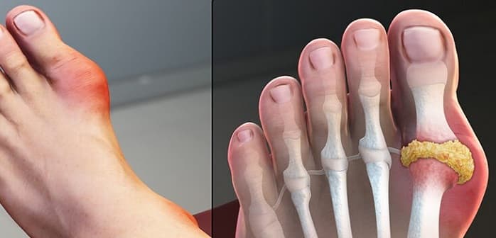 مضرات مصرف گوشت و افزایش خطر ابتلا به نقرس 1 8e5511a4 8f88 49dd 8973 50011dccf962