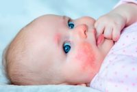 تاثیر مصرف شیر گاو بر تشدید مشکلات پوستی کودکان تاثیر مصرف شیر گاو بر تشدید مشکلات پوستی کودکان