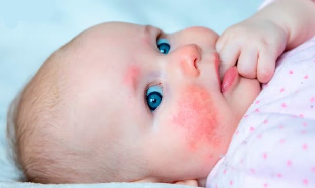 تاثیر مصرف شیر گاو بر تشدید مشکلات پوستی کودکان